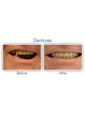 Chrome Dentures - Dental Speciality Clinic