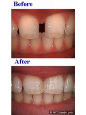 Dental Bonding - Dental Speciality Clinic
