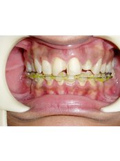 Veneers - Dr Chopra's Implant and Orthodontic Clinic -Central Delhi