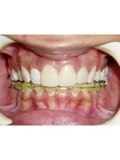 Veneers - Dr Chopra's Implant and Orthodontic Clinic -Central Delhi