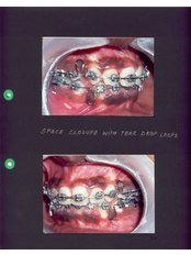 Braces - Dr Chopra's Implant and Orthodontic Clinic -Central Delhi