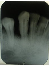 Bone Graft  - Dr Chopra's Implant and Orthodontic Clinic -Central Delhi