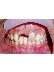Dental Bridges - Dr Chopra's Implant and Orthodontic Clinic -Central Delhi