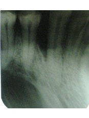 Bone Graft  - Dr Chopra's Implant and Orthodontic Clinic -Central Delhi
