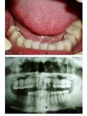 Dental Implants - Dr Chopra's Implant & Orthodontic Clinic