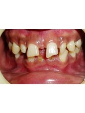 Zirconia Crown - Dr Chopra's Implant & Orthodontic Clinic