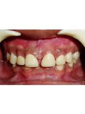 Zirconia Crown - Dr Chopra's Implant & Orthodontic Clinic