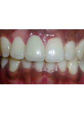 PFM Crown - Dr Chopra's Implant & Orthodontic Clinic