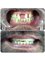 Dr Kochhars  Children| Dental & Orthodontic Centre - zirconia 3m bridge with 15 year warranty..best aesthetics  
