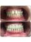 Dr Kochhars  Children| Dental & Orthodontic Centre - smile designing with venners 