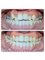 Dr Kochhars  Children| Dental & Orthodontic Centre - 6 month smile by braces and laminates 