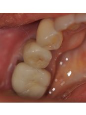 Dental Implants - Kalra Dental Clinic - Defence Colony
