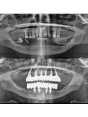 Sinus Lift - Stunning Dentistry