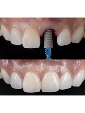 Single Implant - Stunning Dentistry