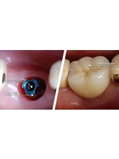 Restoration of Implants - Stunning Dentistry