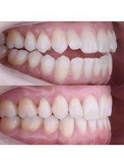 Invisalign™ - Stunning Dentistry