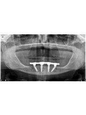 All-on-4 Dental Implants - Stunning Dentistry