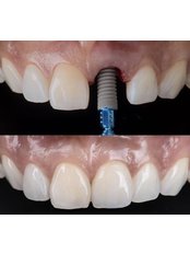 Dental Implants - Stunning Dentistry