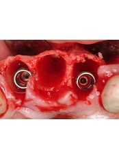 Immediate Implant Placement - Dentafix Multispecialty Dental Clinic