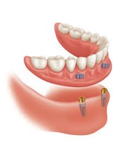Dentures - Dentafix Multispecialty Dental Clinic