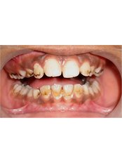 Gingivitis Treatment - Dr Jindal's Dental and Oral Health Clinic