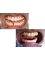 Dr Jindal's Dental and Oral Health Clinic - Replacement of missing tooth 