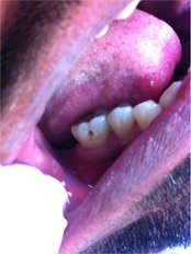 White Filling - Dr Jindal's Dental and Oral Health Clinic