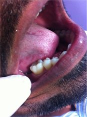 White Filling - Dr Jindal's Dental and Oral Health Clinic