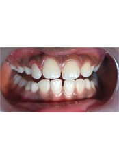 Gingivitis Treatment - Dr Jindal's Dental and Oral Health Clinic