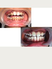 Dr Jindal's Dental and Oral Health Clinic - scaling and polishing of teeth