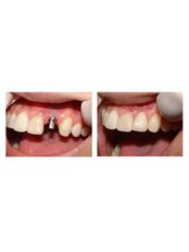 Dental Implants - En Bloc Dental clinic