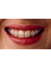 Ceramic Braces - En Bloc Dental clinic