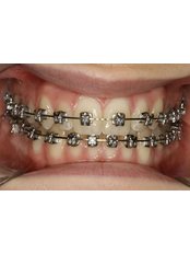 Metal Braces - En Bloc Dental clinic