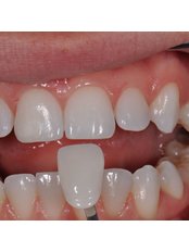 Veneers - smilewide dental clinic