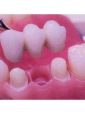 Dental Bridges - smilewide dental clinic
