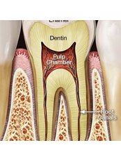 Root Canals - smilewide dental clinic