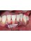 Magadh Oro Dental - Implant & Orthodontic Clinic - Periodontal Flap Surgery & Bone Grafting 