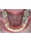 Magadh Oro Dental & Orthodontic Clinic - Space Maintainer 