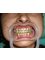 Magadh Oro Dental & Orthodontic Clinic - Metal Braces 