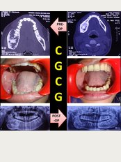 R D DENTAL HOSPITAL & RESEARCH CENTRE - Conservative Management of CGCG