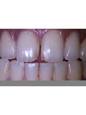 Composite Veneers - Dental Wiz