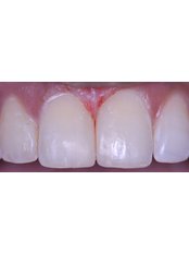 Composite Veneers - Dental Wiz
