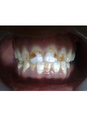 Teeth Whitening - DENTALWORLD - SUYASH HOSPITAL