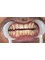 Dr. Kadu's Orthodontic And Dental Clinic -  Zirconia (3M) Bridge with lower teeth 