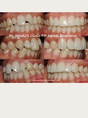 DR. PANDIT'S CLINIC FOR DENTAL EXCELLENCE & IMPLANT CENTRE PASHAN PUNE - Dr Pandit's Clinic for dental excellence and implant centre 411021 Sterling Horizon Sus road   Near Reliance Fresh , Pashan Pune 411021, Pune, maharashtra,India, 411021, 