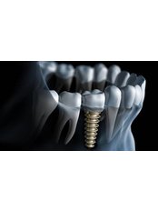 Dental Implant - Dental Tree Jalandhar (Dental Implants & Invisible Braces Specialty Centre)