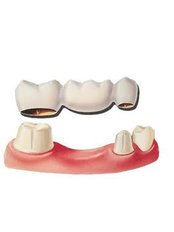 Dental Bridges - Thind Dental Clinic