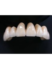 Porcelain Bridge - Thind Dental Clinic