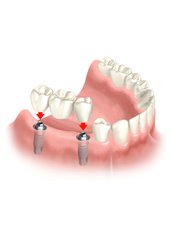 Implant Bridge - Thind Dental Clinic