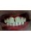 Aashvi Dental Care - after treatment photograph(toot bleaching) 